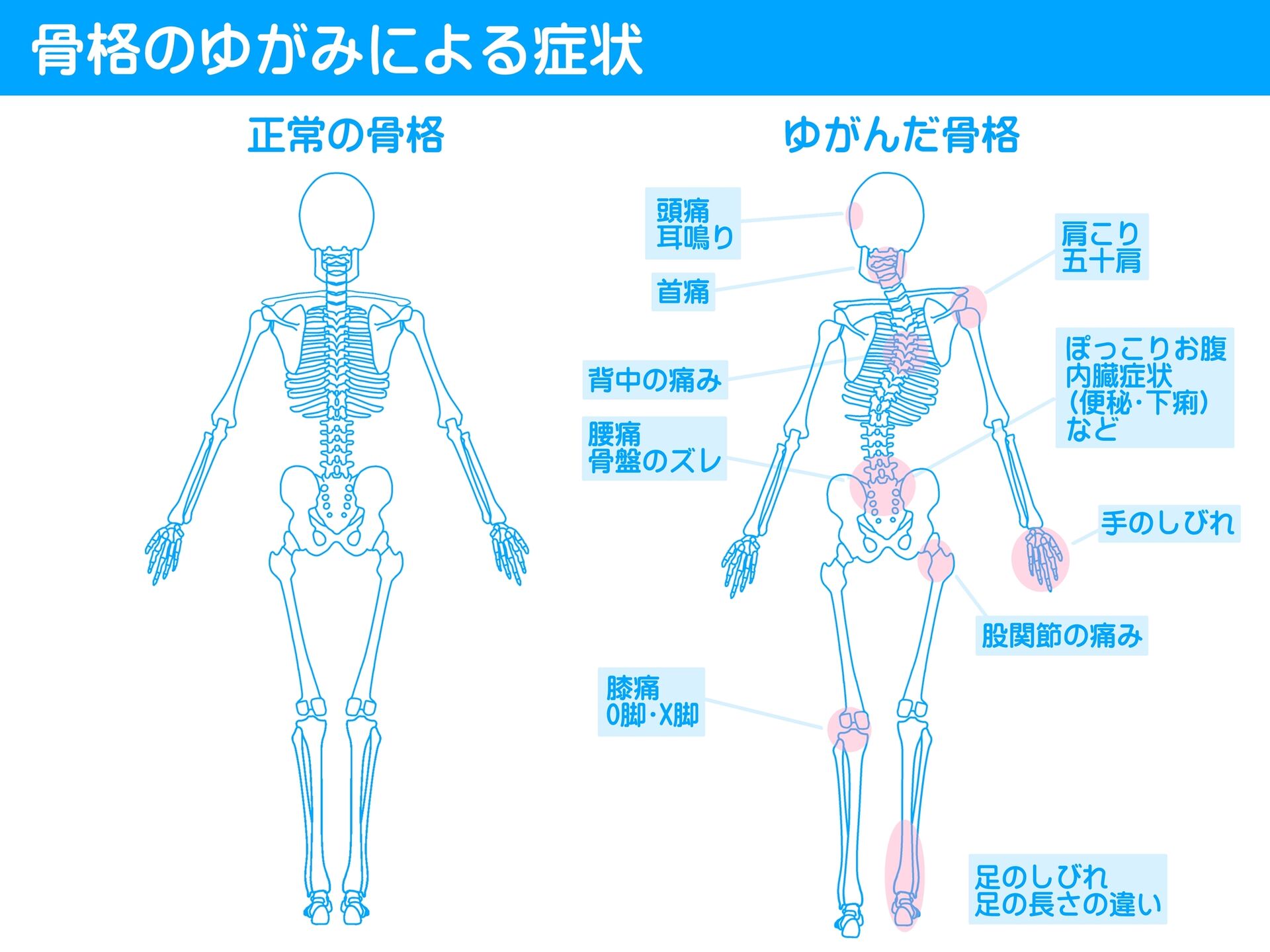 ゆがみ２